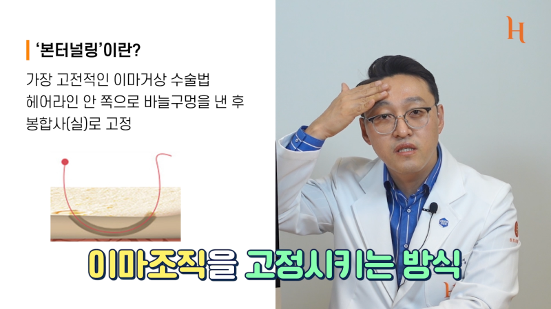 내시경이마거상술 수술방법 2가지 사진 4