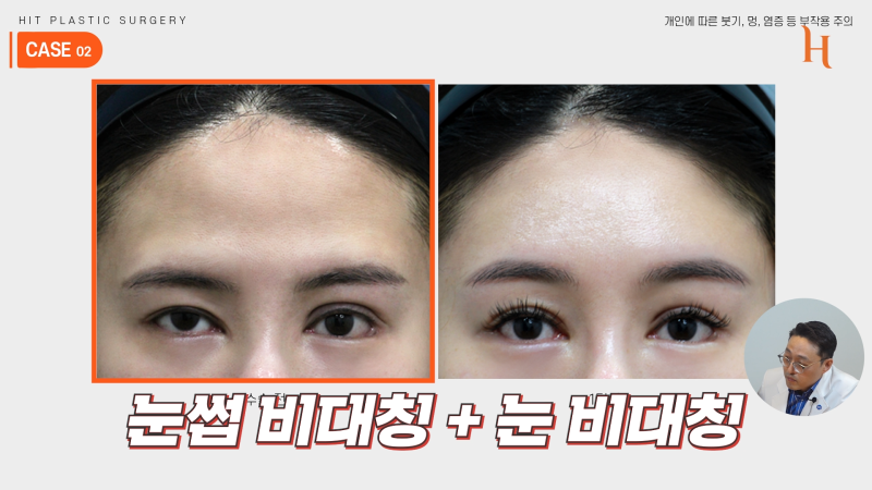 내시경 이마거상 수술 후기 (엔도타인, 본터널링) 사진 7