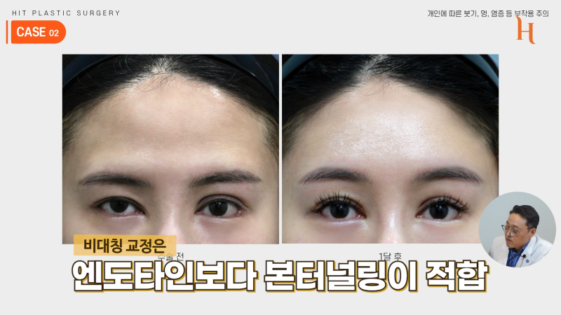 내시경 이마거상 수술 후기 (엔도타인, 본터널링) 사진 9
