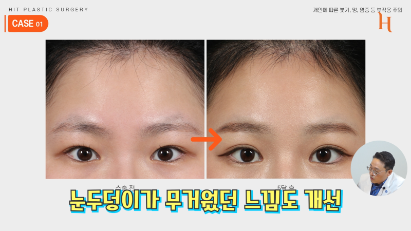 내시경 이마거상 수술 후기 (엔도타인, 본터널링) 사진 5