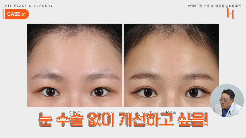 내시경 이마거상 수술 후기 (엔도타인, 본터널링) 사진 3