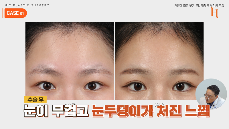 내시경 이마거상 수술 후기 (엔도타인, 본터널링)