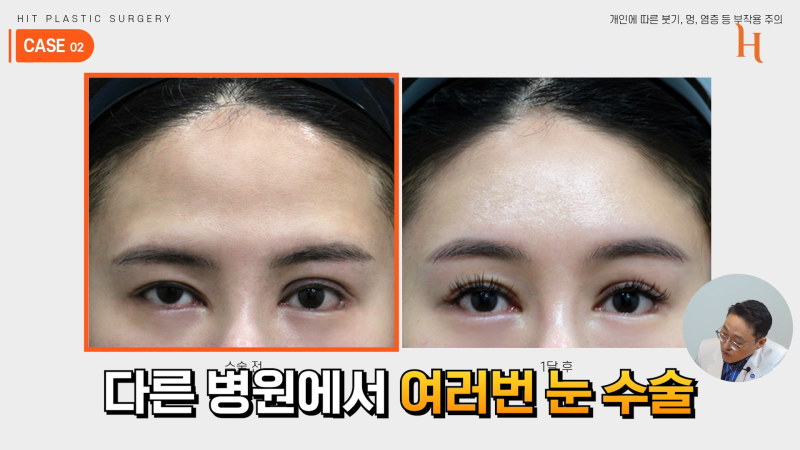 내시경 이마거상 수술 후기 (엔도타인, 본터널링) 사진 6