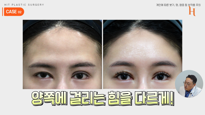 내시경 이마거상 수술 후기 (엔도타인, 본터널링) 사진 8
