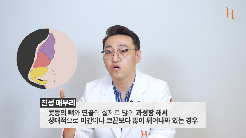 매부리코도 자라난다? 메부리 원인 사진 7