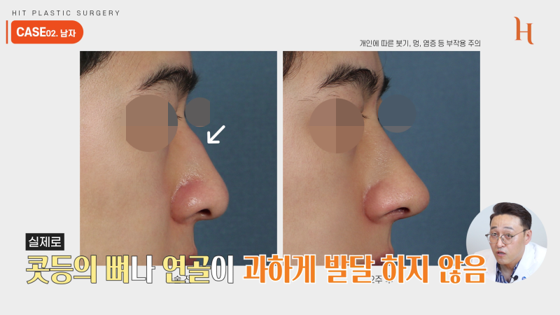 매부리깎기 수술 할 필요 없다? 사진 9