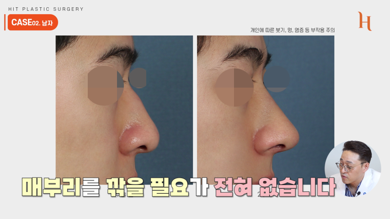매부리깎기 수술 할 필요 없다? 사진 10