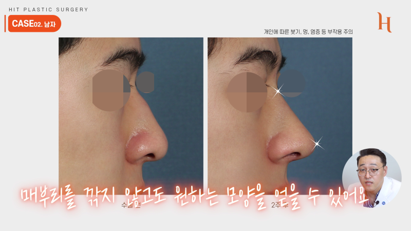 매부리깎기 수술 할 필요 없다? 사진 11