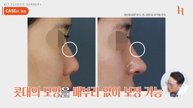 매부리깎기 수술 할 필요 없다? 사진 8