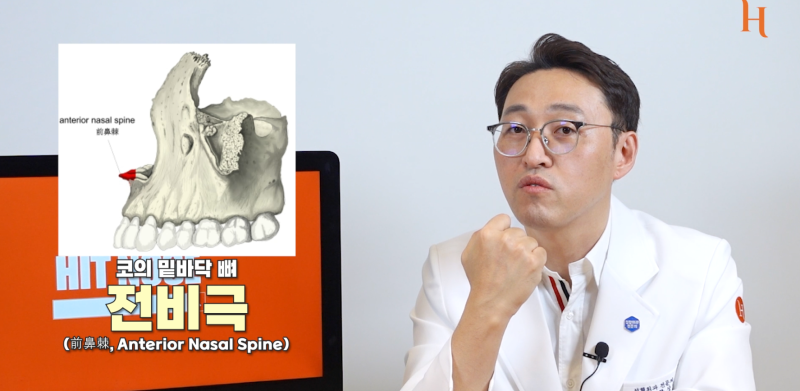 중안면부를 개선하는 인중각도 (비순각 교정, 고양이수술) 사진 7