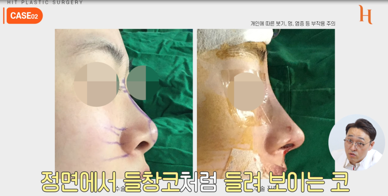 중안면부를 개선하는 인중각도 (비순각 교정, 고양이수술) 사진 10