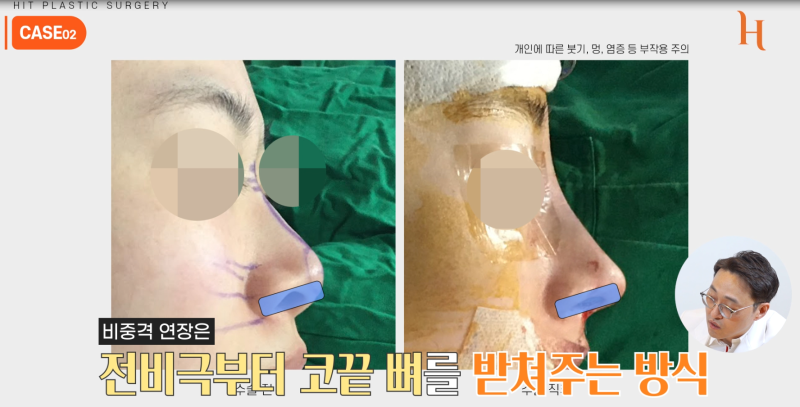 중안면부를 개선하는 인중각도 (비순각 교정, 고양이수술)