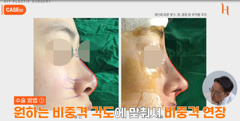 중안면부를 개선하는 인중각도 (비순각 교정, 고양이수술) 사진 12