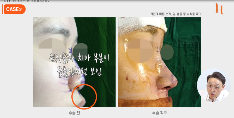 중안면부를 개선하는 인중각도 (비순각 교정, 고양이수술) 사진 9