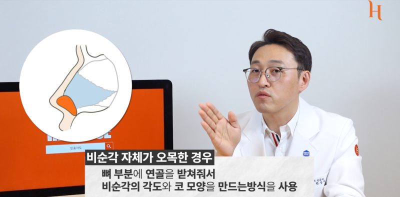 중안면부를 개선하는 인중각도 (비순각 교정, 고양이수술) 사진 5
