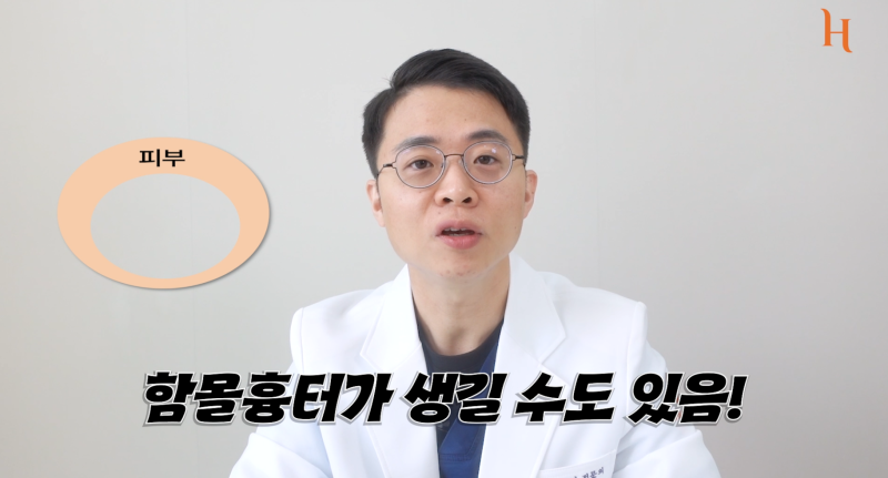 눈두덩이지방 = 마시멜로 (눈성형방법) 사진 6
