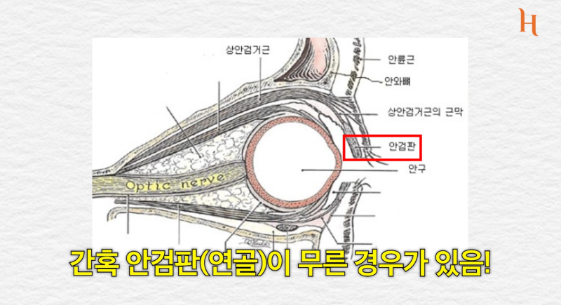 벽시계를 닮은 쌍꺼풀수술 : 히트성형외과 사진 5