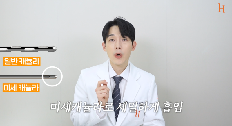 얼굴지방흡입, 실리프팅 : 얼굴살없애는법 사진 2