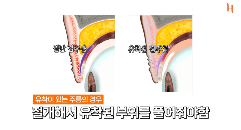 눈겹주름 쌍꺼풀이 아닙니다 사진 9