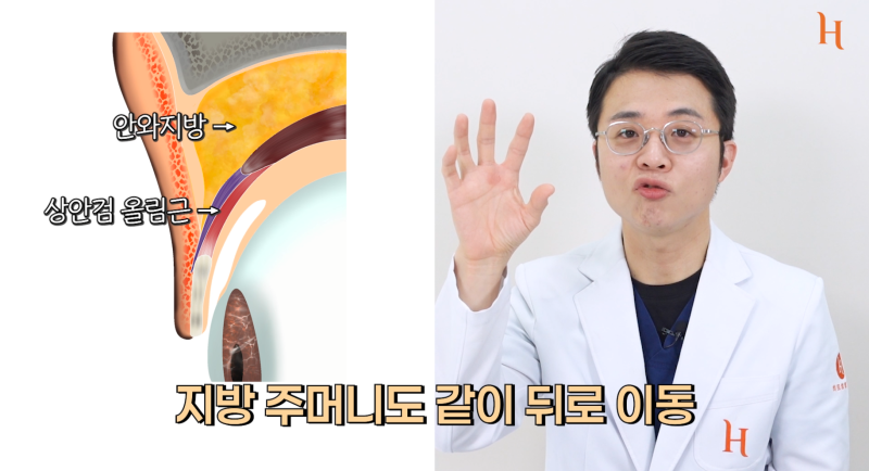 눈위지방이식 꺼진눈 해결 방법 사진 13