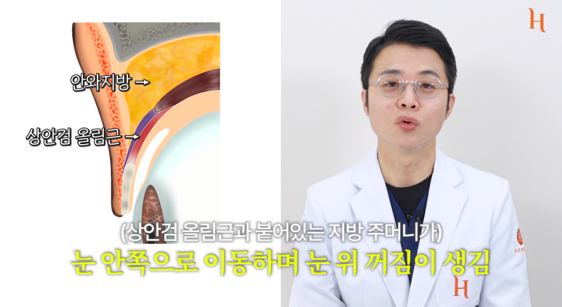 눈위지방이식 꺼진눈 해결 방법 사진 5