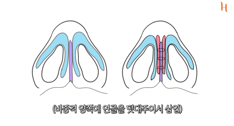 코수술 후 위험한 증상 9가지! 사진 4
