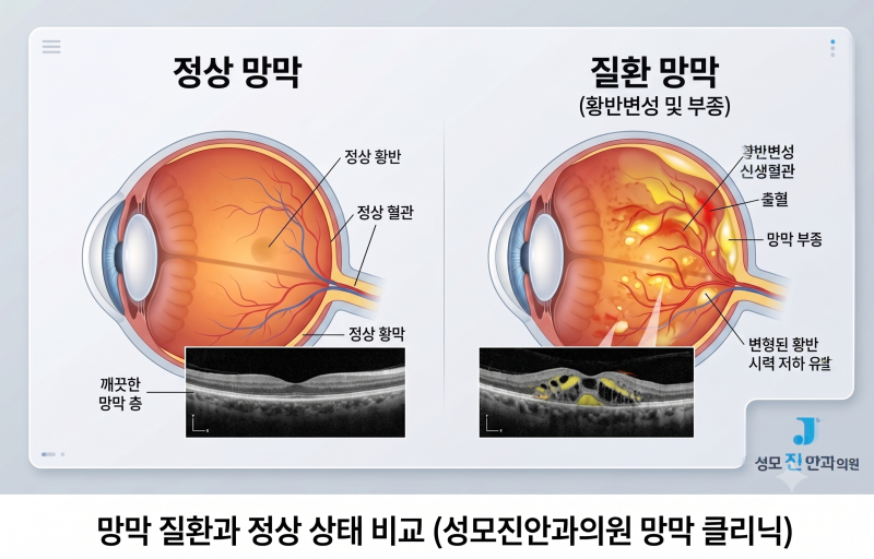 눈에 주사를 맞는다? 망막주사 치료가 필요한 이유와 통증 줄이는 팁