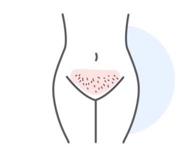 [서면제이린] 올누드브라질리언 레이저제모 런칭!