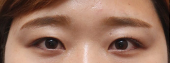 内双·半开式·开放式双眼皮的种类和区别