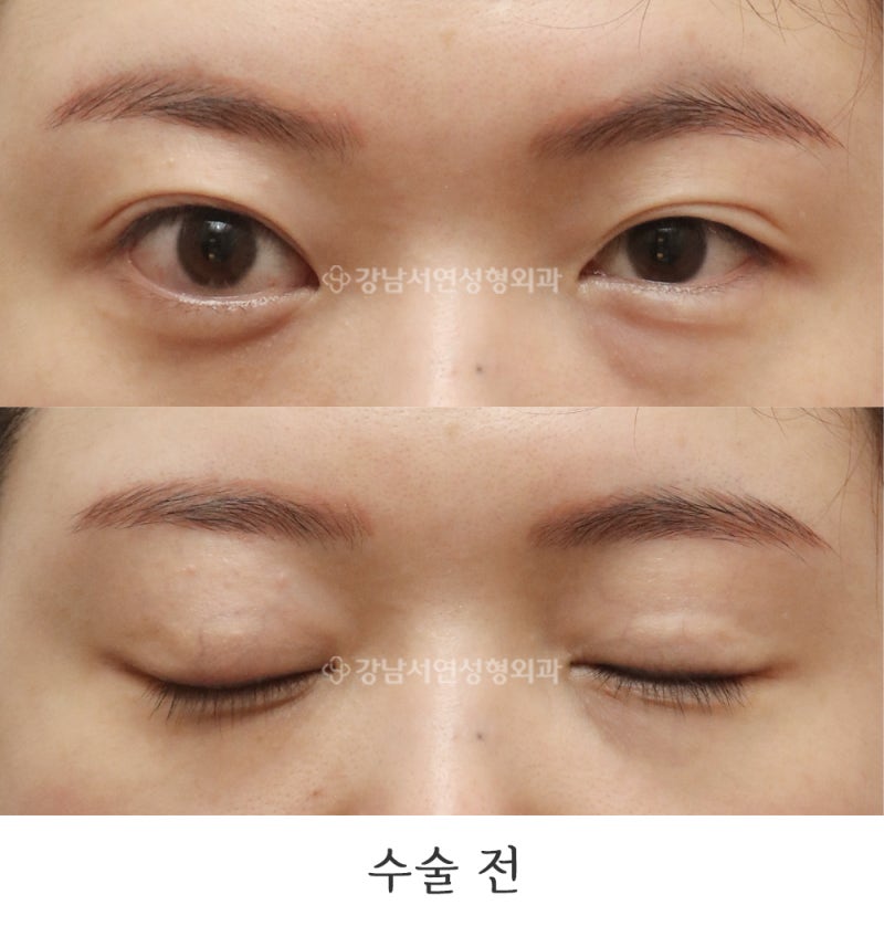 切开法眼提肌矫正修复手术 6个月前后对比照（feat.江南瑞妍整形外科）