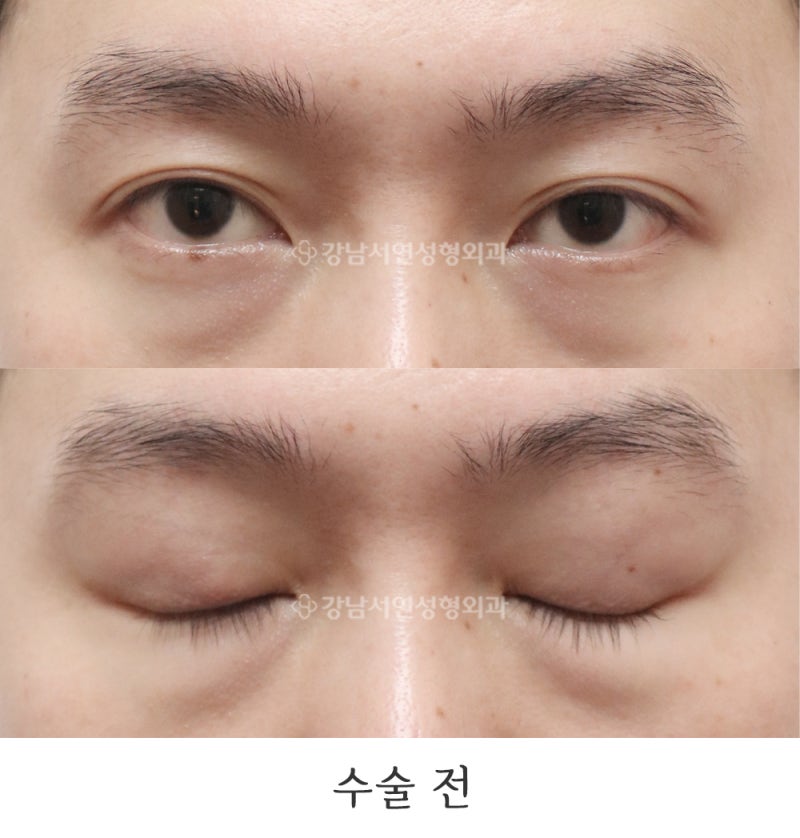 消除雙眼皮、單眼皮提肌矯正術 6 個月前後對比照（feat. 江南瑞妍整形外科）