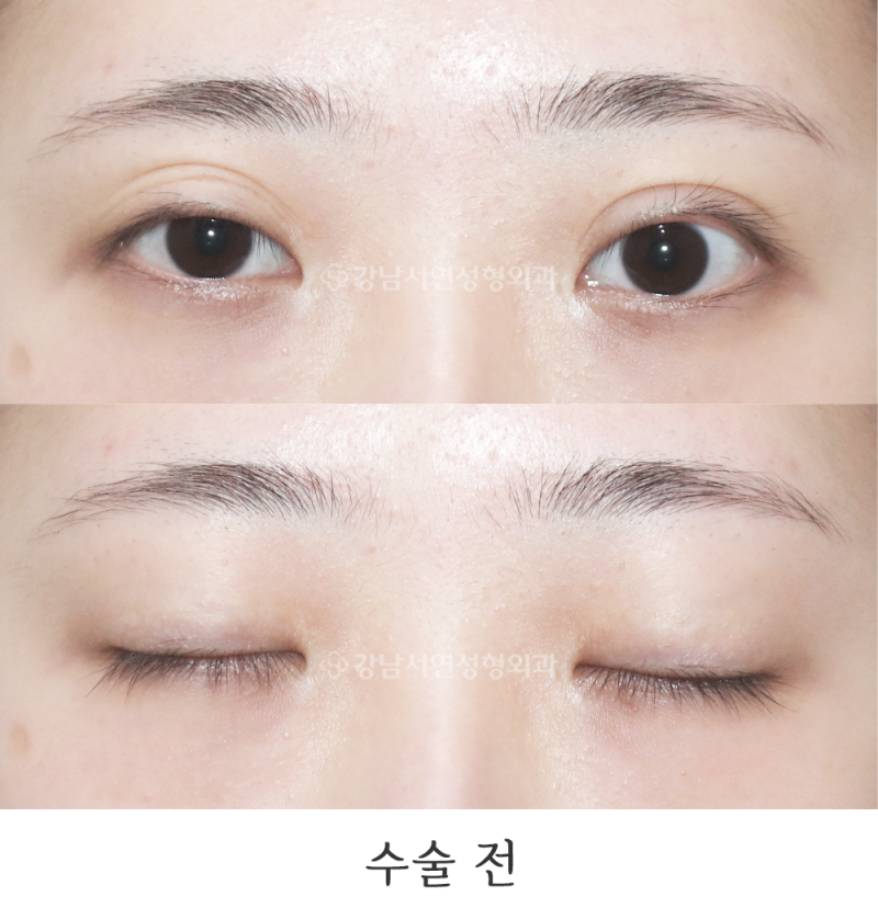 江南瑞妍整形外科双眼皮修复手术（睑缘外翻、大小眼矫正）前后对比照
