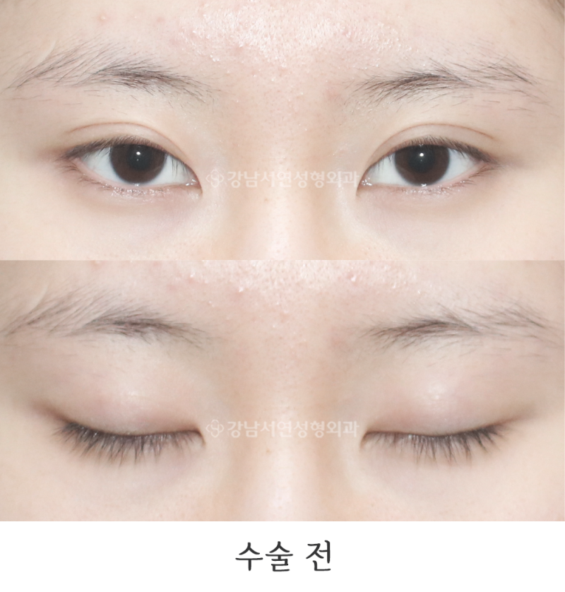 ภาพก่อนและหลังการทำศัลยกรรมลดขนาดชั้นตา (Dujulttagi) ณ Gangnam Seoyeon Plastic Surgery