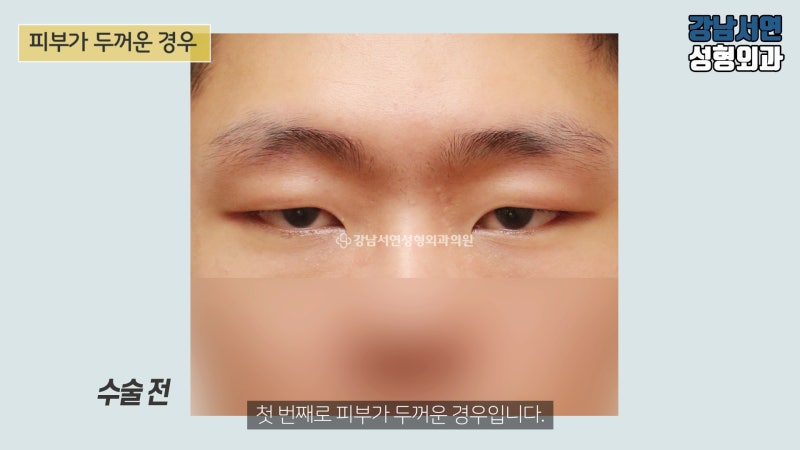 为什么男性不建议做非切开式眼提肌手术