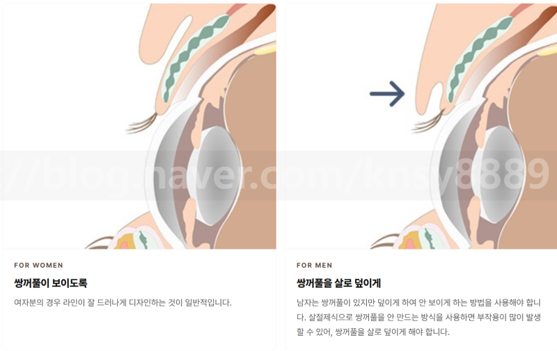 남자 인상을 좌우하는 것은? '쌍꺼풀 없애기' 하는 진짜 이유