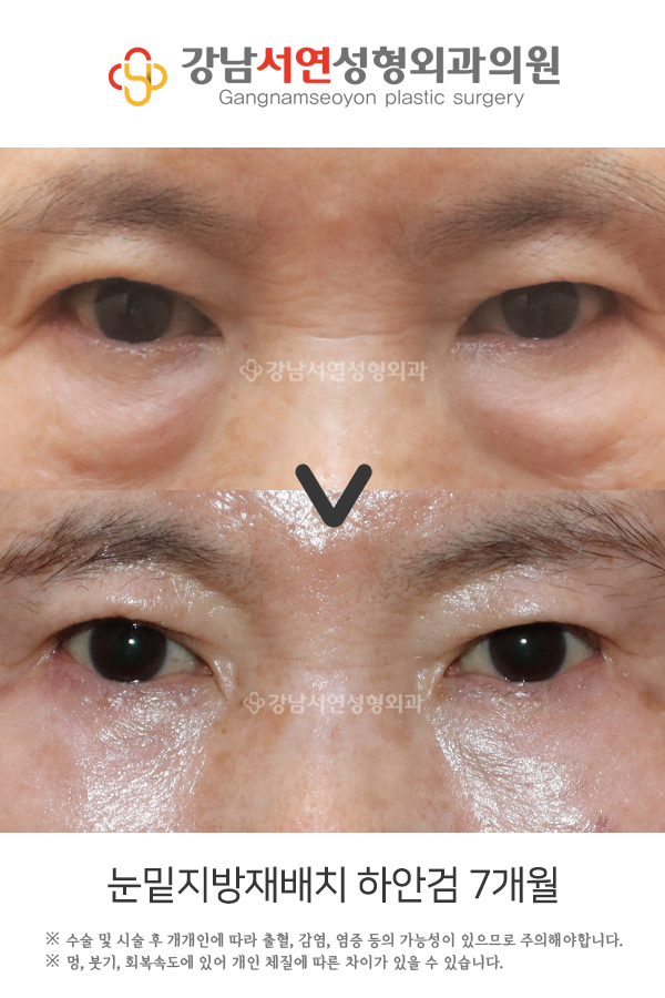 하안검, 눈밑지방재배치술 차이 _ 눈밑 처짐과 다크서클의 차이 사진 6