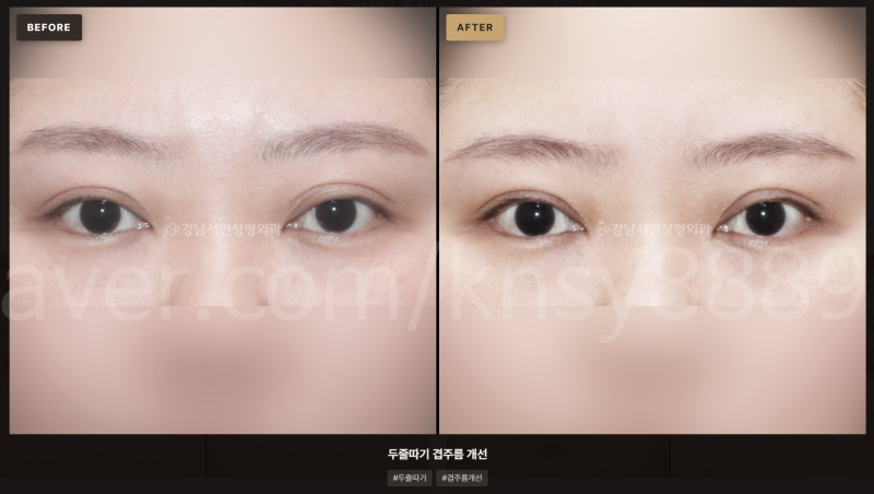 두줄따기 후 겹주름, 왜 생기고 어떻게 막을 수 있나요?