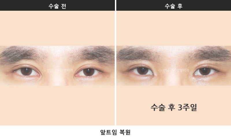 开内眼角修复，恢复期需要多久？ _ 开内眼角修复前后对比照片