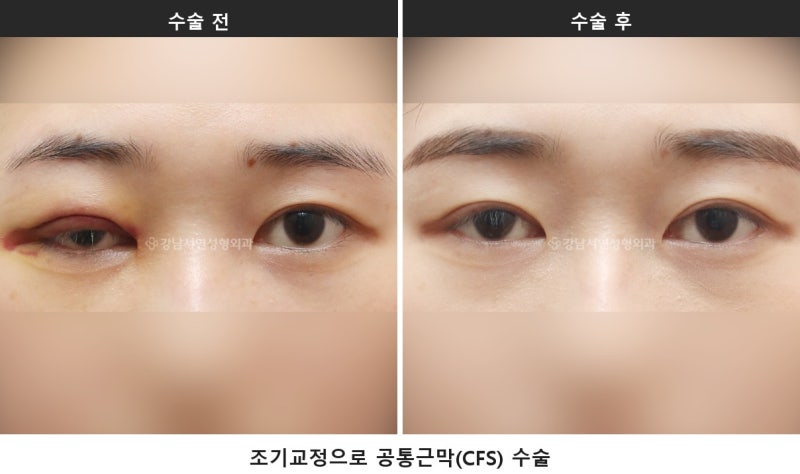망한 쌍수, 눈매교정 과교정·겹주름, 조기교정 골든타임 안에 가능합니다 사진 5