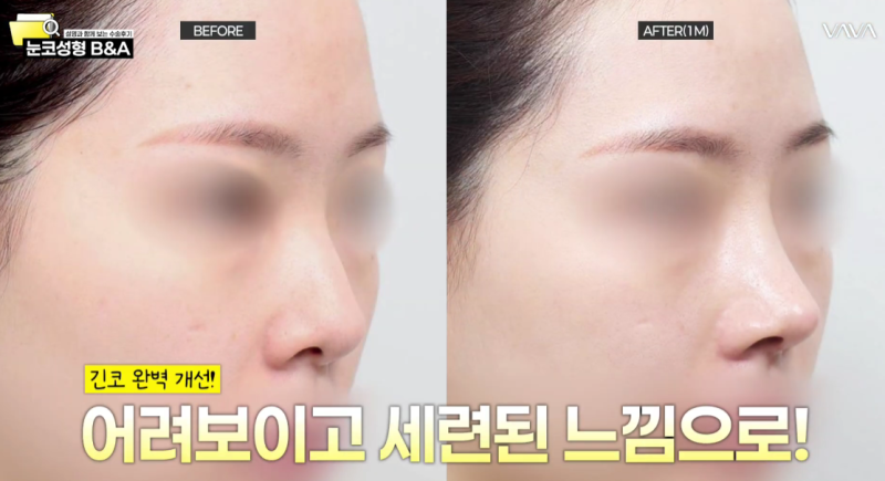 Bulbous Nose, Hump Nose, Long Nose Correction | Before & After Rhinoplasty Cases (NJZ Minji Nose)