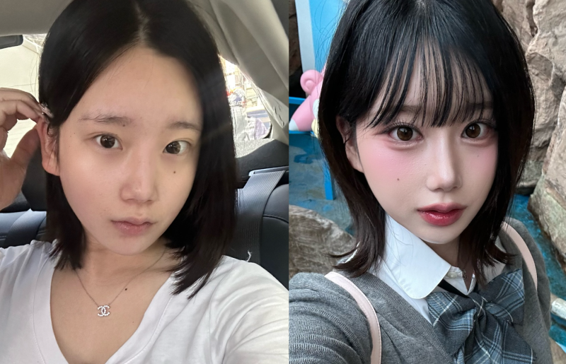 바바성형외과 눈·코 성형 한 달 차 리얼 케이스 (윈터, 카리나 코)