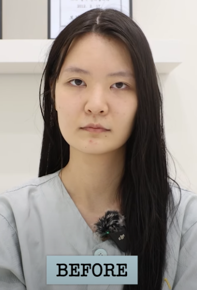 Operasi Hidung Baba Plastic Surgery: Koreksi Hidung Babi, Hidung Bengkok, dan Hidung Elang Secara Bersamaan! Ulasan Nyata Operasi Hidung Garis Lurus-Melengkung