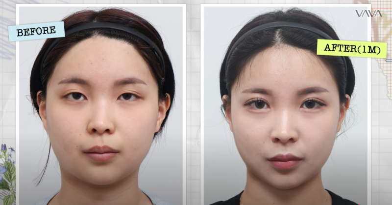 쌍수 재수술 성공기 ｜ 졸려보이는 눈 세미아웃으로 예뻐진 리얼 Before & After