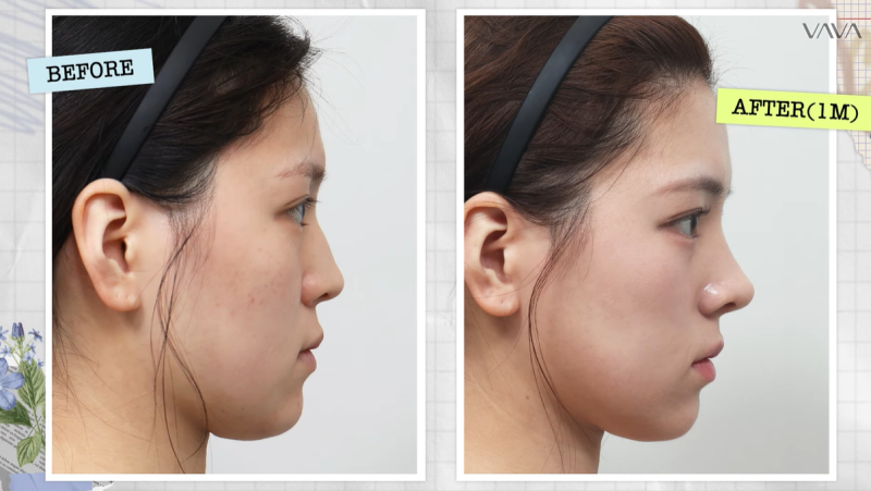 Jelas Tanpa Implan｜Ulasan Nyata Koreksi Hidung Bungkuk Tanpa Implan di Baba Plastic Surgery