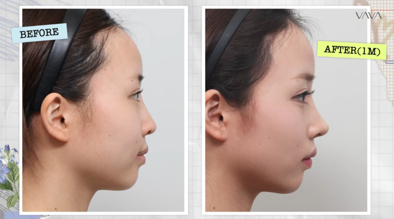 Can Revision Rhinoplasty Change Your Impression? | VAVA Plastic Surgery Semi-Curved Nose Revision Review