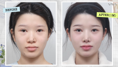 Ulasan Rhinoplasty Tulang Rawan Rusuk Autologus di Apgujeong VAVA Plastic Surgery | Perubahan Satu Bulan Setelah Koreksi Hidung Babi dan Hidung Bengkok