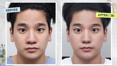 Perbaikan Hidung Babi dan Hidung Gemuk dengan Rhinoplasti Garis Lurus Tanpa Implan｜Kasus Baba Plastic Surgery Apgujeong