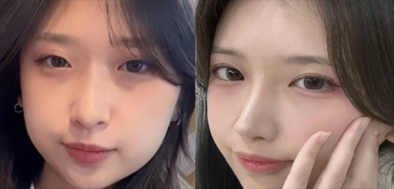 눈이랑 코 같이 하면 더 예뻐질까? ㅣ  동시성형 솔직 정리