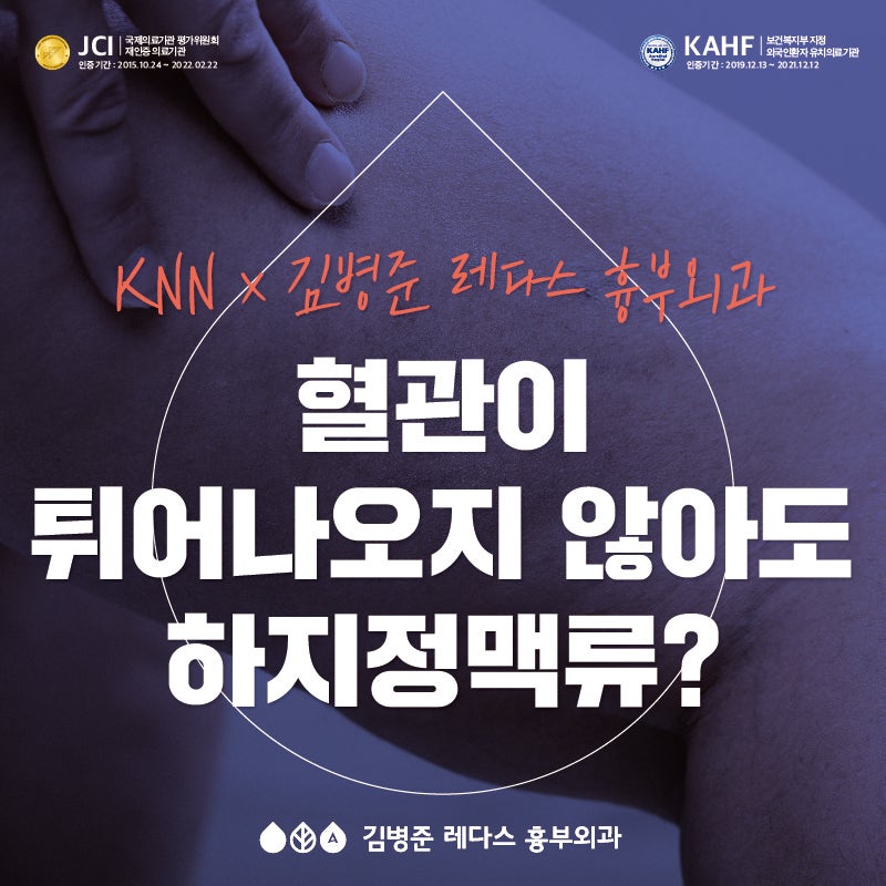 [건강365] 혈관이 튀어나오지 않아도 하지정맥류?