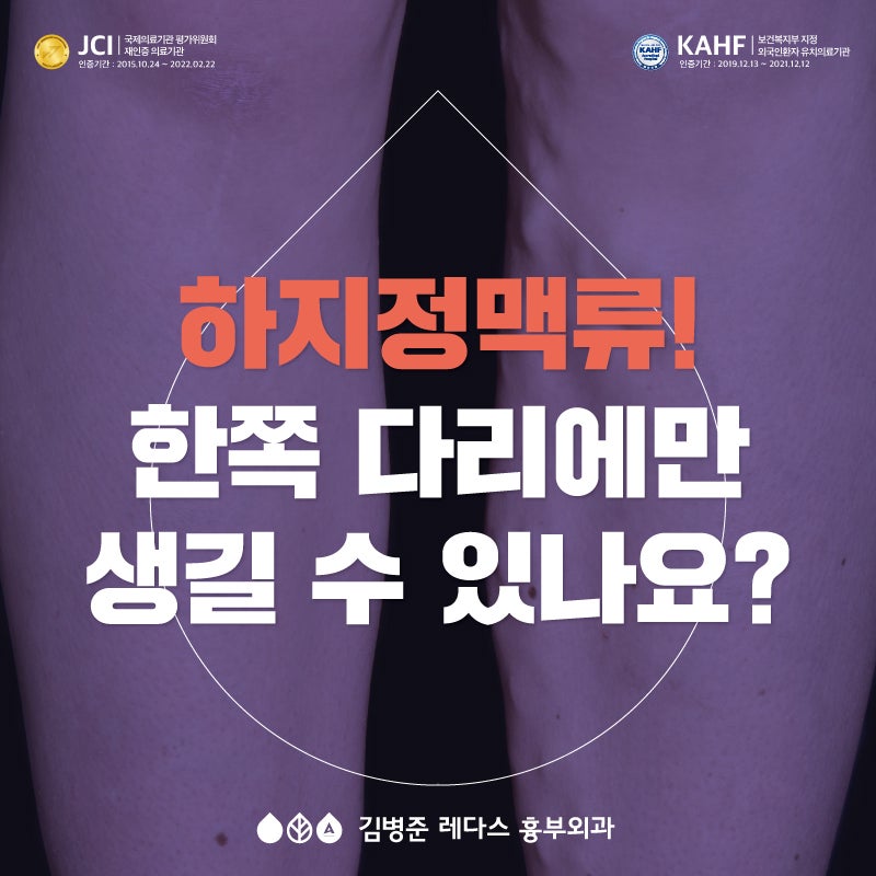 한쪽 다리만 하지정맥류가 생길 수 있나요?
